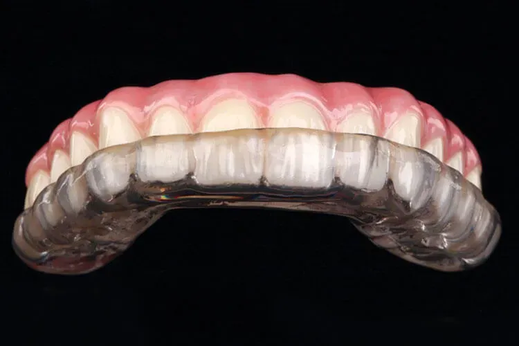A clear bite guard over a dental model.