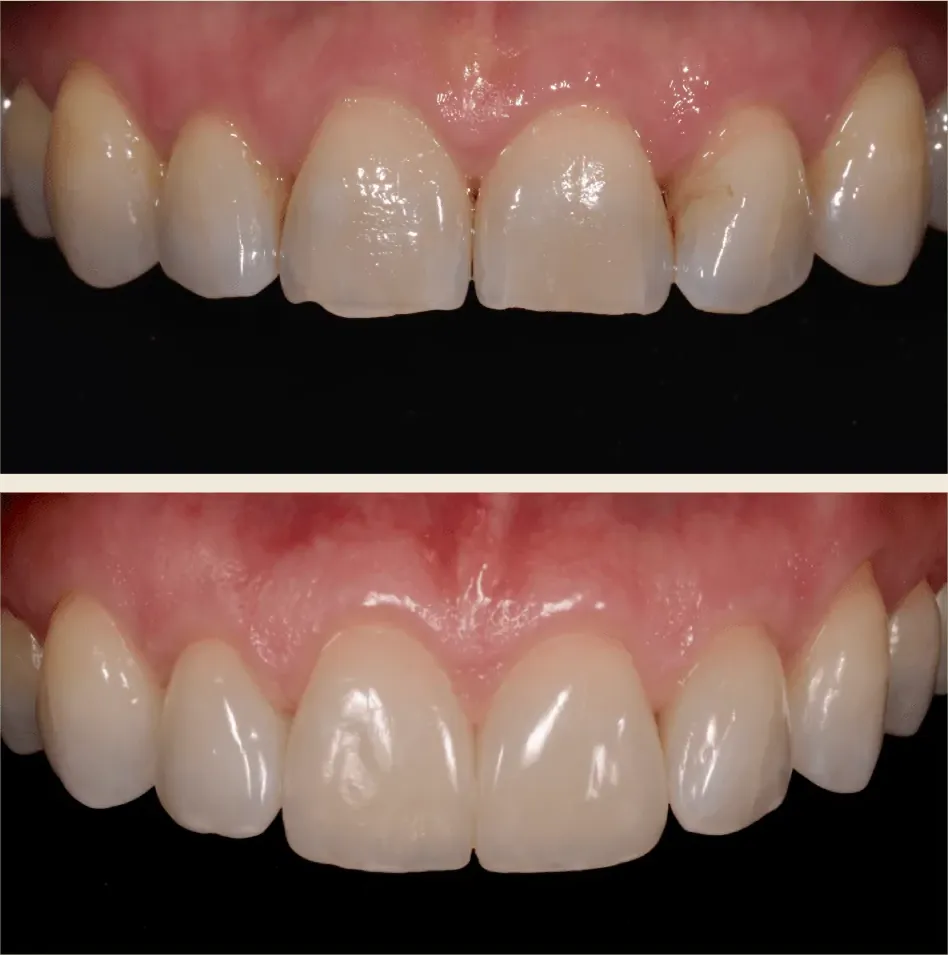 Front teeth before and after veneers have been placed.